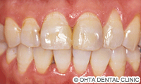 治療前_歯の表面が汚い場合（虫歯治療跡が凸凹している）