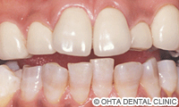 治療後_テトラサイクリン着色歯が重症の場合（下顎の歯はホワイトニング