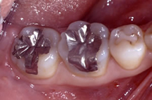 治療前_臼歯部咬合面（奥歯のかみ合わせ部分）の充填例