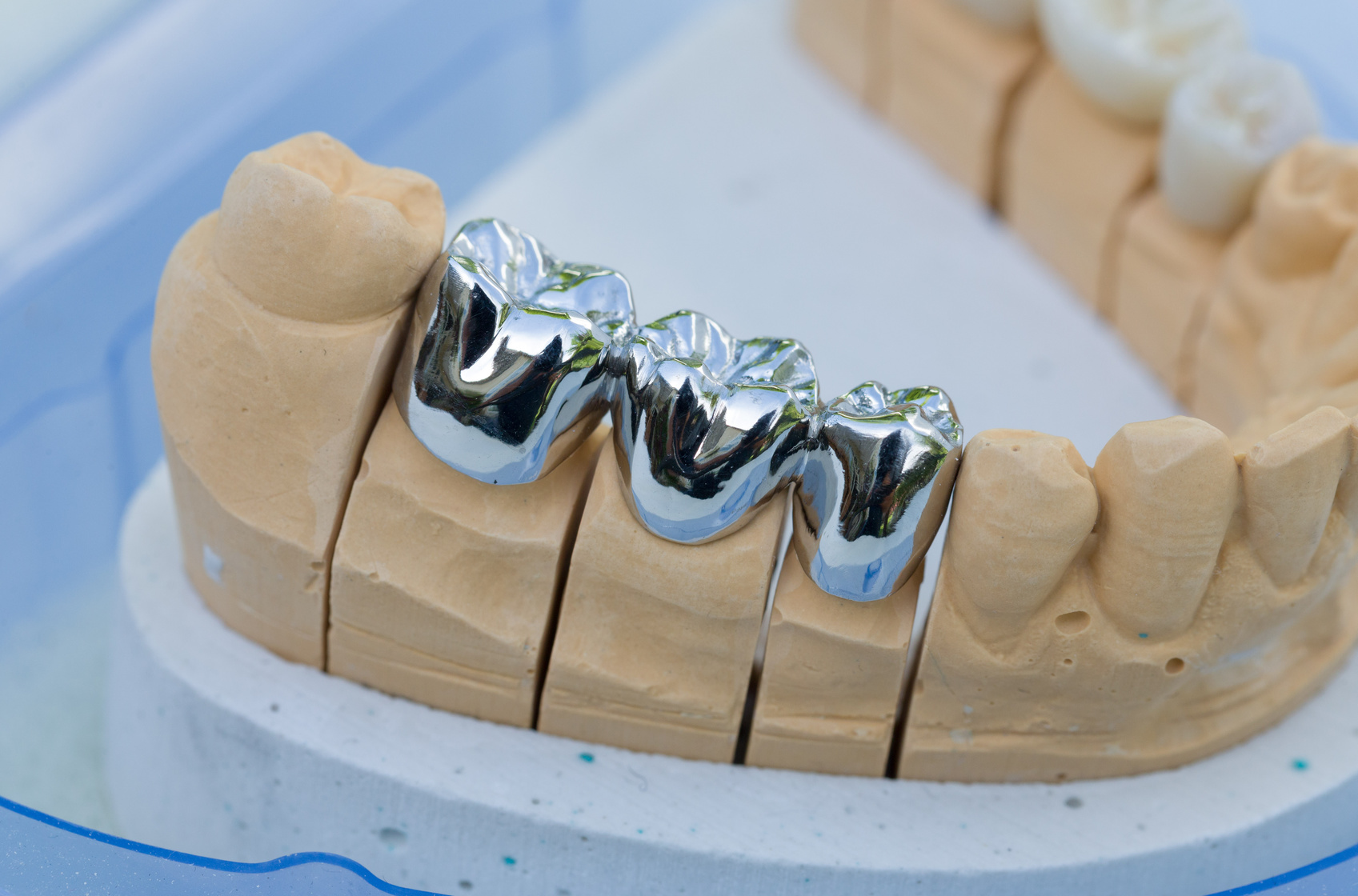 銀歯や入れ歯の金属はチタン？歯科用金属の種類とは？ | 審美歯科ネット