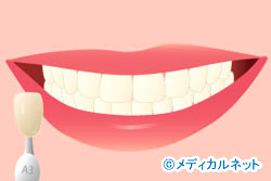 歯を白くしたい(ホワイトニング)