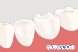 被せ物を白くしたい