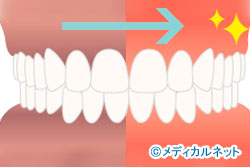 歯茎の黒ずみを取りたい(ガムブリーチ)